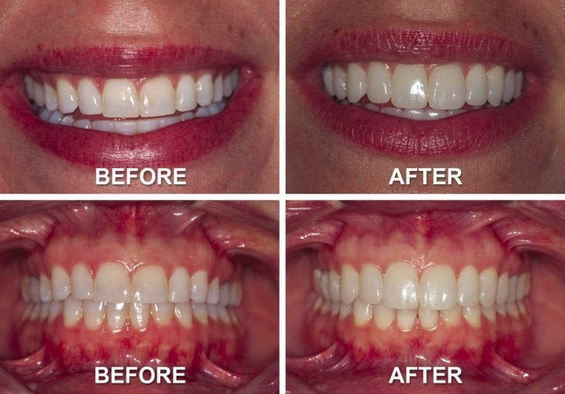 Best ABQ Dentist - Before and After