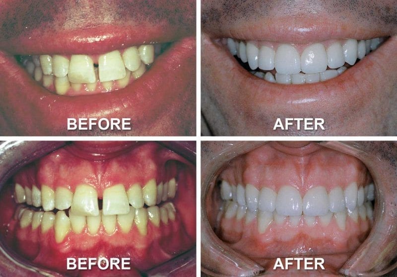 Best Albuquerque Dentist - Before and After