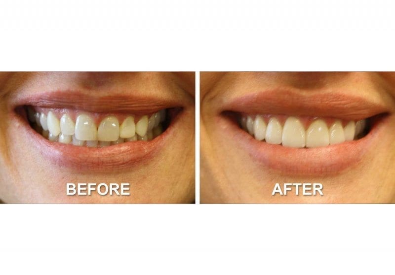 Before and After Smile