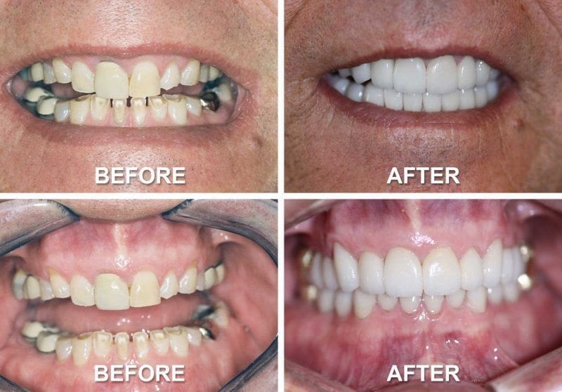 LoPour Dentistry - Before and After