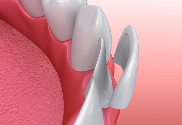 Depiction of How Dental Veneers Work
