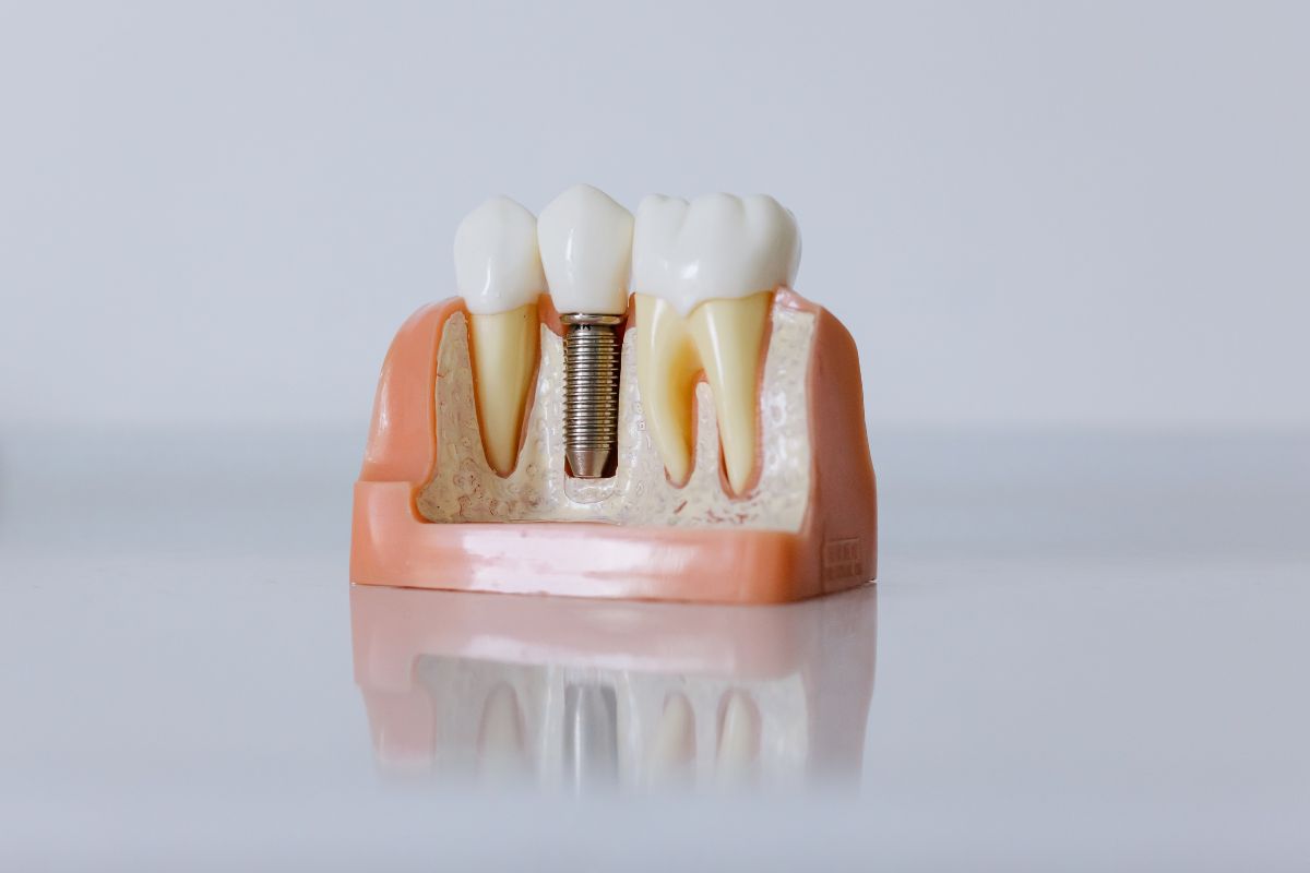 How Long Do Dental Implants Last