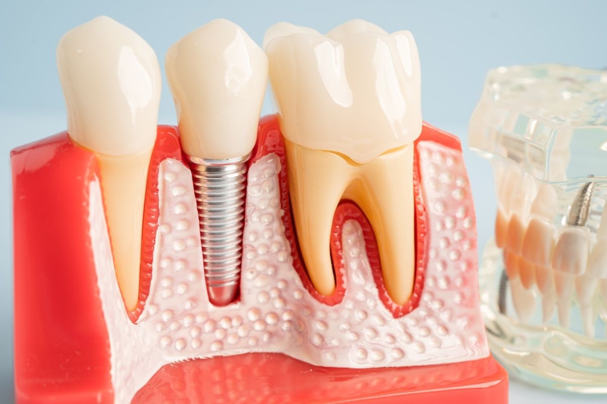 Can Gums Grow Around Dental Implants?
