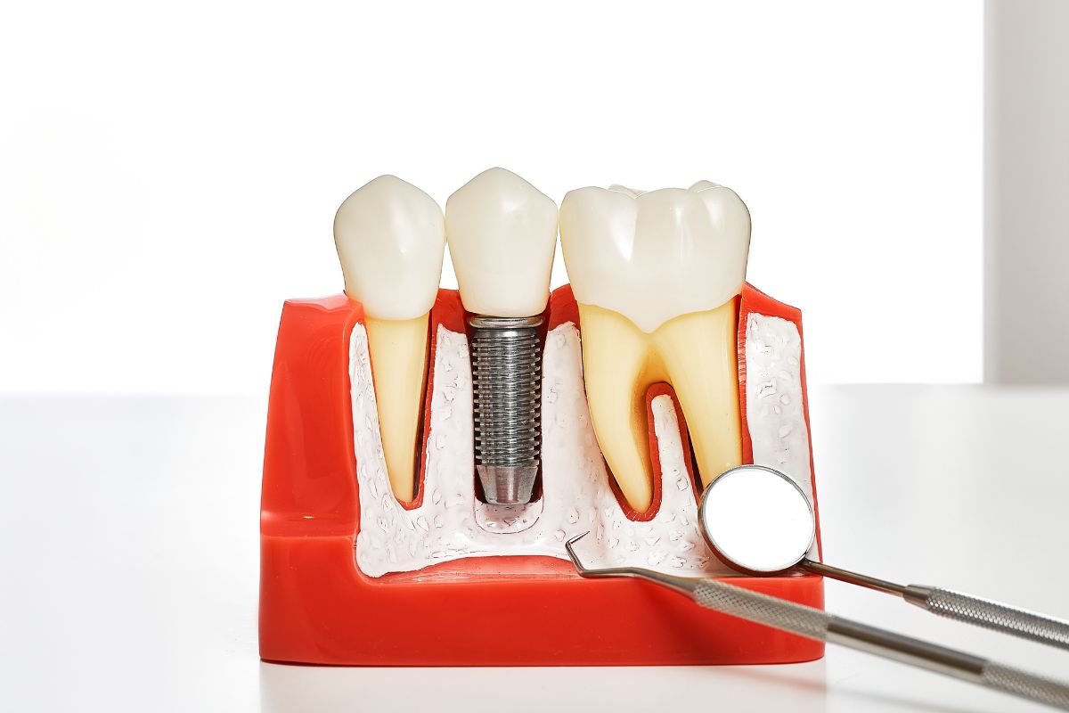 How Dental Implants Work?