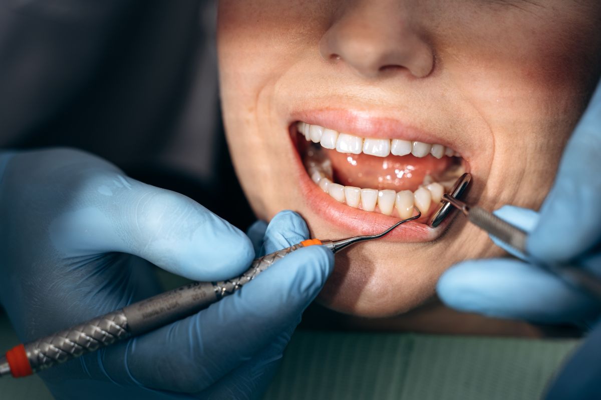 Treat Your Dental Gaps with Veneers in Albuquerque