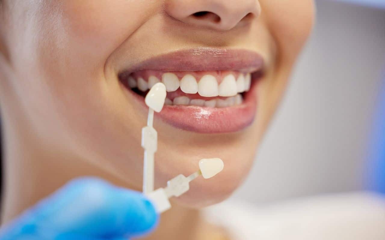 Dental shade guide being held next to patient's smile to compare tooth whitening results.