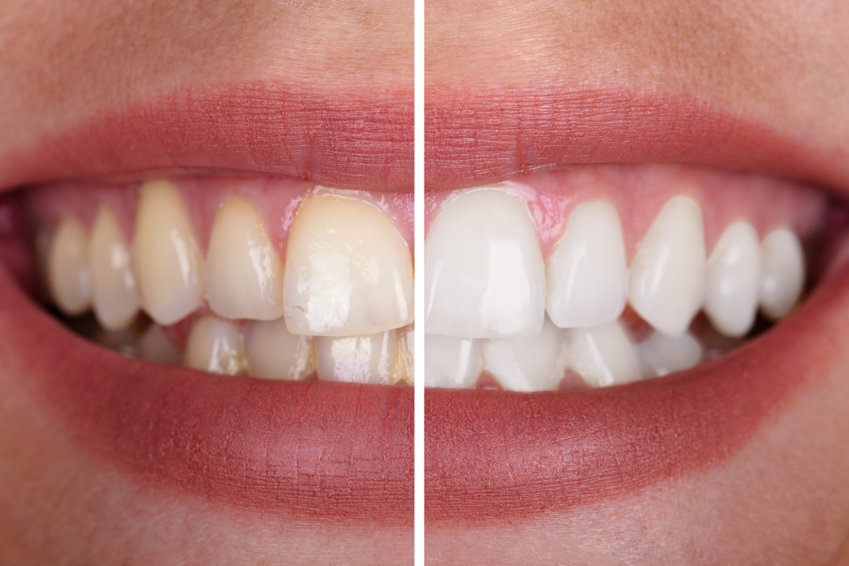 Will Teeth Whitening Remove Stains