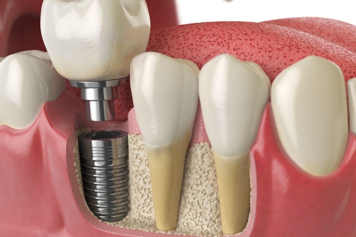 dental implants in Albuquerque