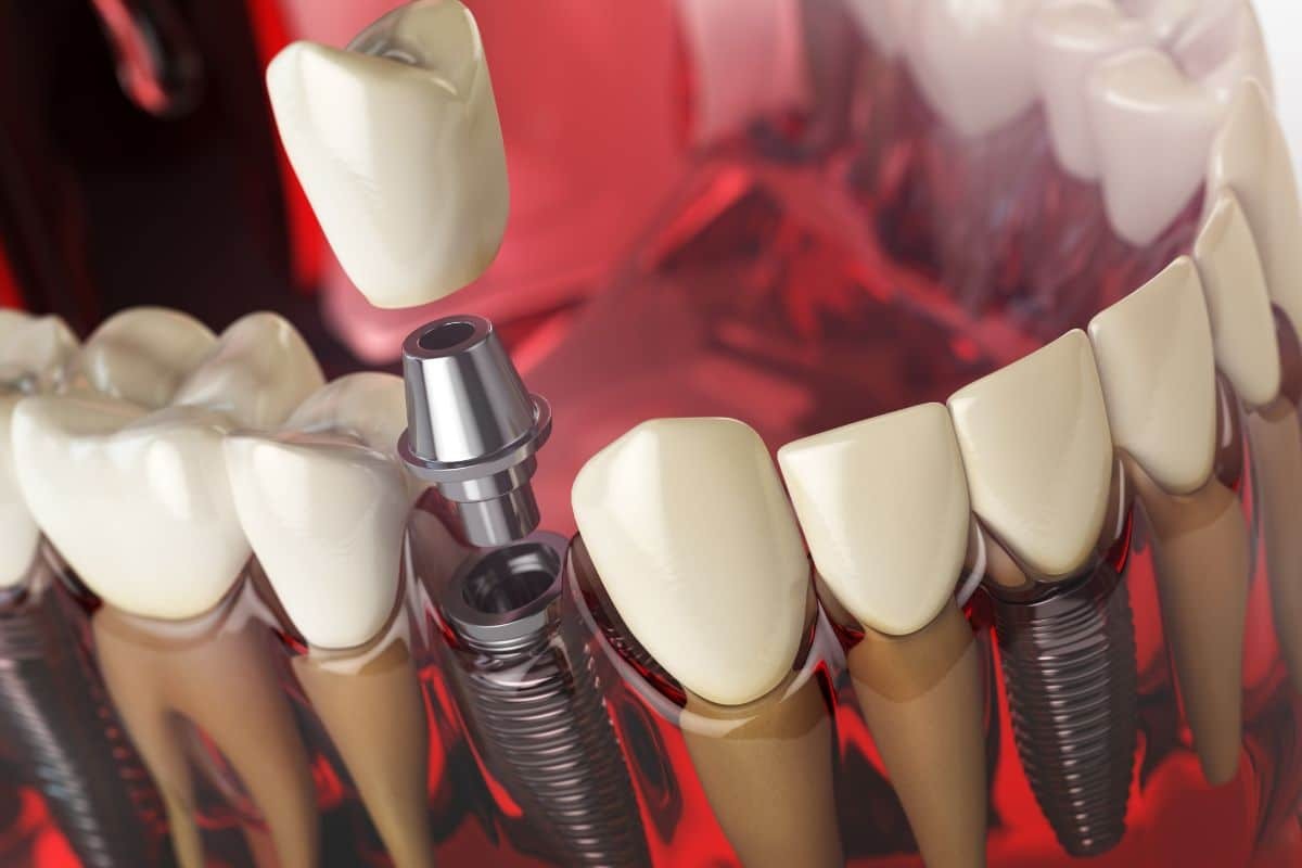 Dental implant illustration showing multiple crown restorations on titanium implant posts integrated into jawbone.