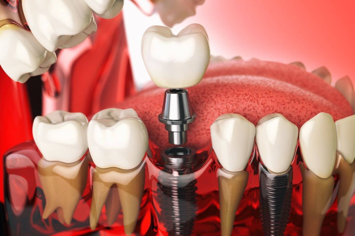 Dental implant illustration showing a tooth crown, implant fixture, and abutment among natural teeth.